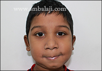 Face asymmetry corrected following surgery