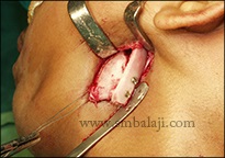 Gap arthroplasty surgery with costochongral graft