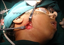 Gap arthroplasty surgery - TM joint reconstruction with rib graft secured to mandible with titanium screws