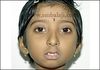 Improved facial appearance and chin made more prominent following surgery
