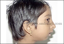 Enhanced facial profile following surgery