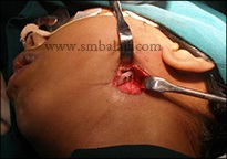 TM joint reconstruction with rib graft secured to mandible with titanium screws