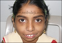 Postoperative view showing symmetric face with prominent chin