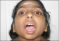 Increased mouth opening a few days after surgery