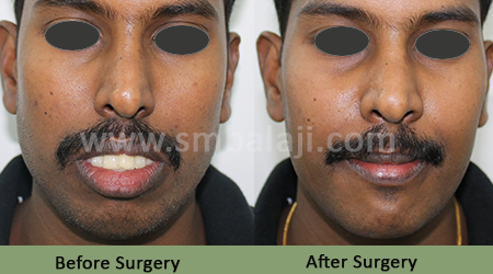 Upper jaw protrusion - Before After Picture