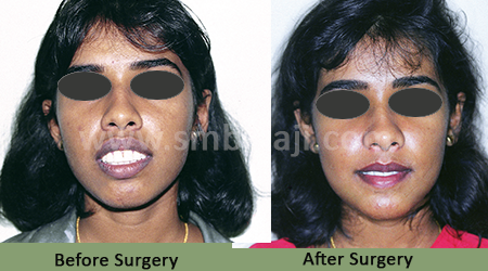 Upper jaw protrusion - Before After Picture