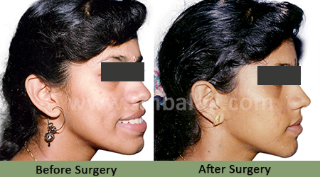 Upper jaw protrusion - Before After Picture