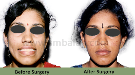 Upper jaw protrusion - Before After Picture