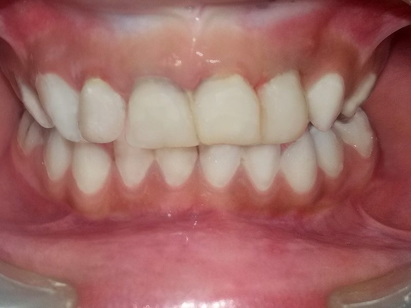 Esthetic crown after picture