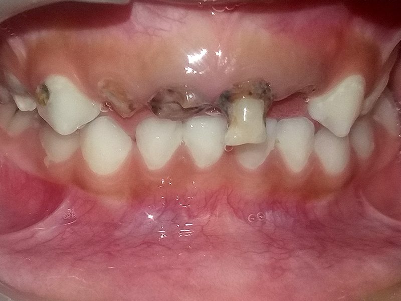 Esthetic crowns before picture