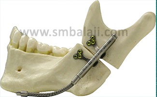 Types of Distraction Osteogenesis 6 Mandibular univector internal distractor with rigid and flexible activation arms