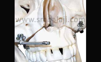 Types of Distraction Osteogenesis 4 Right and left maxillary internal distractors with flexible activation arms that can be easily placed inside the mouth