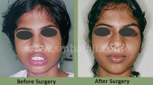 Upper jaw protrusion - Before After Picture