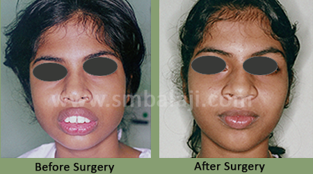 Upper jaw protrusion - Before After Picture