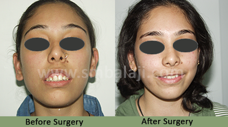 Upper jaw protrusion - Before After Picture