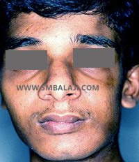 Appearance enhanced after fat graft surgery