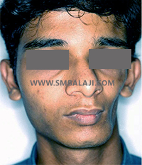 Facial tissue atrophy on left side of the face