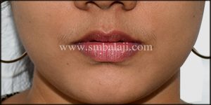 Best Jaw Surgery hospital in india