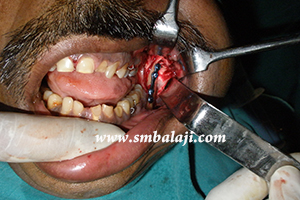 Bone plate fixed