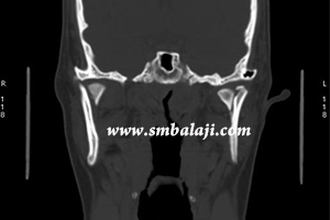 CT showing condylar neck fracture on both sides and displaced inwards