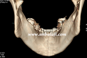 CT showing condylar neck fracture on both sides and displaced inwards