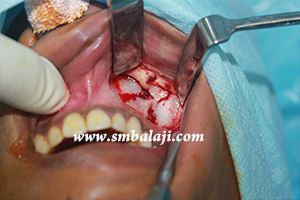 During jaw surgery