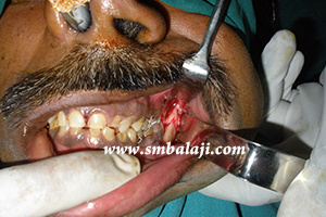 During surgery, the fracture site visualized