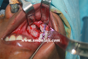 Fractured segments fixed with bone plate