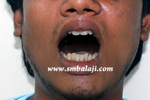 Improved mouth opening postoperatively