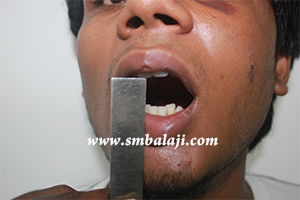 Jaw fracture surgery india