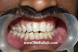Occlusion or the way the patient bites corrected after surgery