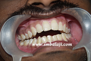 Occlusion or the way the patient bites is affected due to fracture of jaw bone