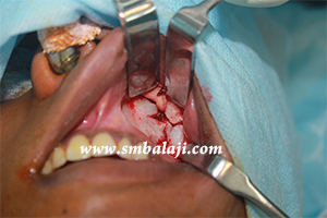 Open reduction of fracture