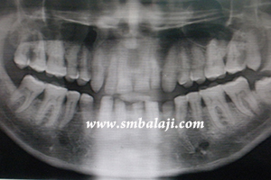 X-ray indicating a fracture in the left side of the lower jaw