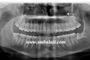 X-ray showing jaw fracture