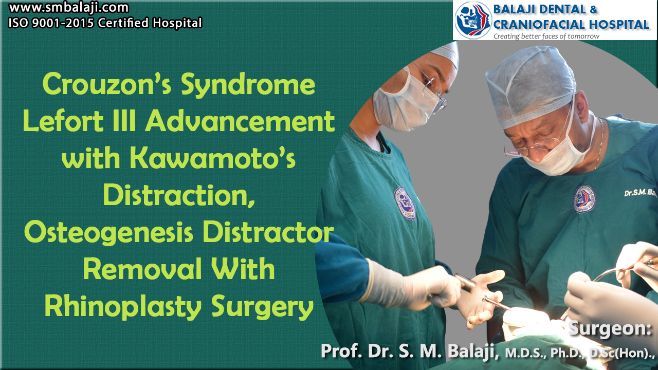 Crouzon Syndrome Lefort III Advancement with Kawamoto’s Distraction, Osteogenesis Distractor Removal With Rhinoplasty Surgery