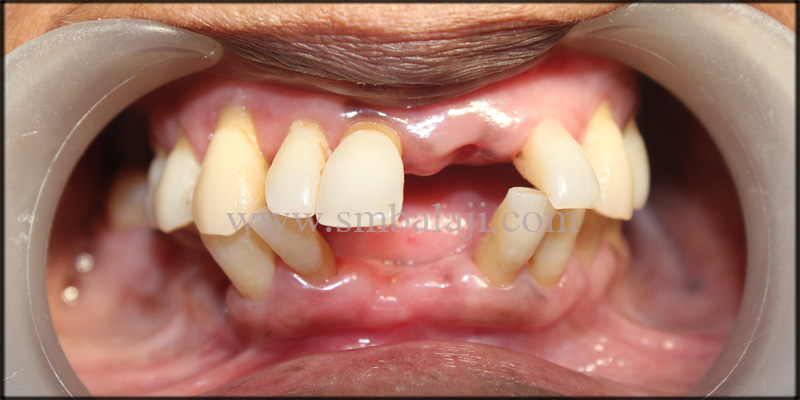 Patient with missing upper and lower anterior teeth