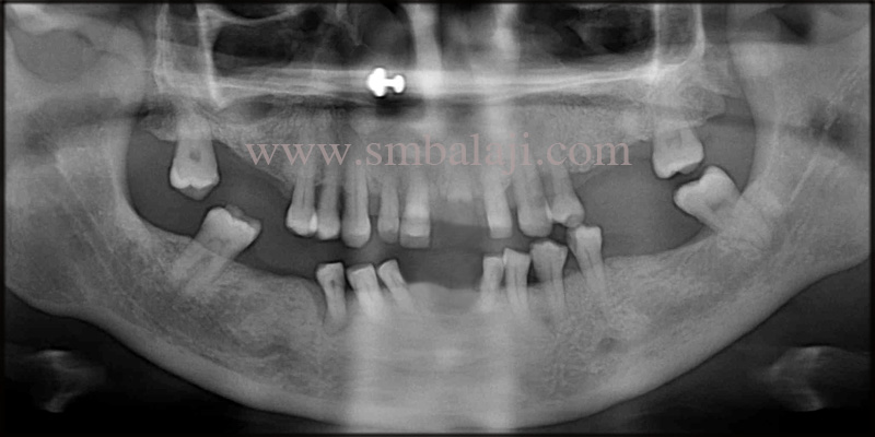 Pre-operative OPG taken shows generalized bone loss and missing teeth in the upper and lower jaw