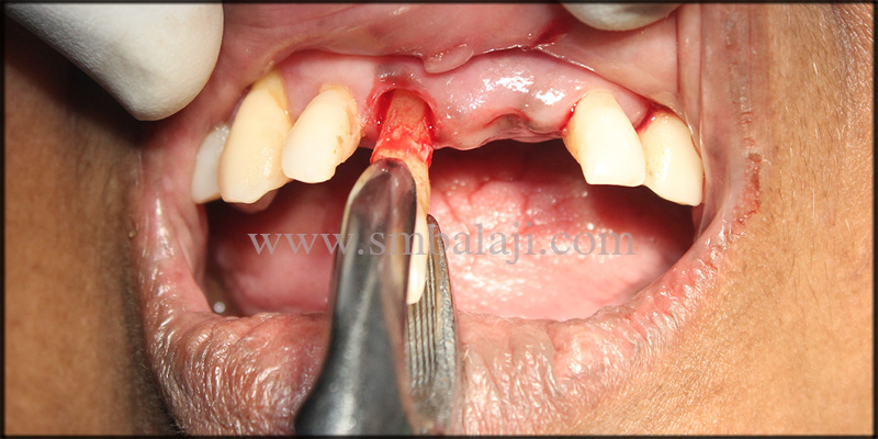 Mobile upper and lower anterior teeth extracted under local anesthesia