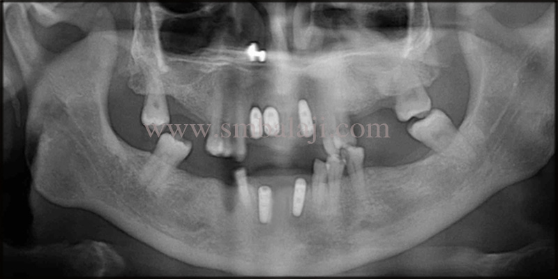 Post-operative OPG shows dental implants in chime with the jaw bone
