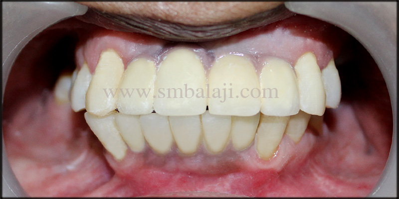 Aesthetically looking ceramic prosthesis fixed on the dental implants