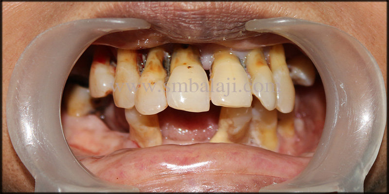Dental Implants for a Beautiful Smile 1 Unhappy patient with compromised teeth condition