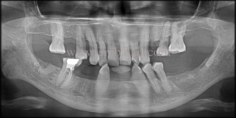 Dental Implants for a Beautiful Smile 2 Pre-operative OPG shows bone loss in upper and lower jaw