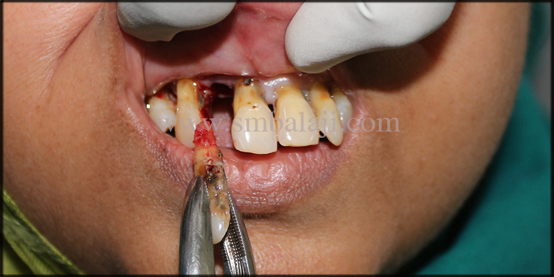 Dental Implants for a Beautiful Smile 3 Extraction of mobile teeth done under local anesthesia in upper and lower jaw