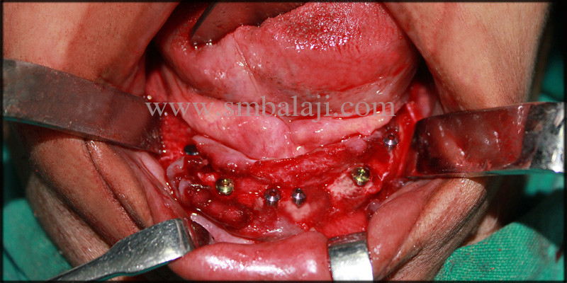 Dental Implants for a Beautiful Smile 4 Dental implants fixed in upper and lower jaw bone