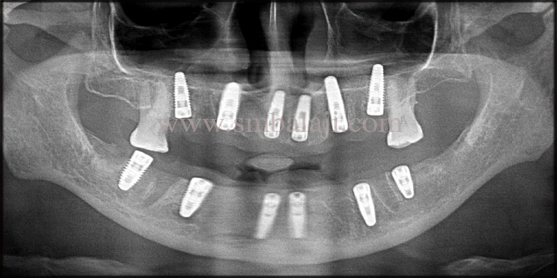 Dental Implants for a Beautiful Smile 5 Post operative OPG shows well osseointegrated dental implants