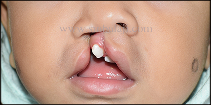 Unilateral cleft lip in a 11 months old baby boy