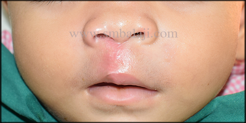 Immediately after suture removal following seven days of surgery showing enhanced appearance