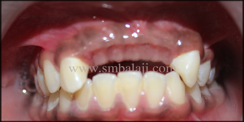 Replacement of Missing Teeth with Dental Implants for a Dazzling Smile 1 Patient with missing upper front teeth
