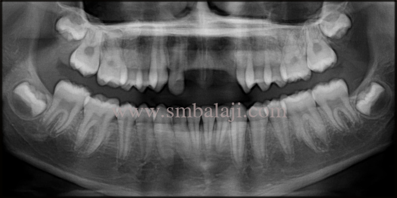 Replacement of Missing Teeth with Dental Implants for a Dazzling Smile 2 Pre-operative OPG shows complete missing of teeth at the involved site with no pathological findings in the surrounding bone structure